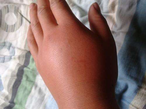 被蜜蜂蜇傷了如何處理 被蜜蜂蜇傷了如何處理